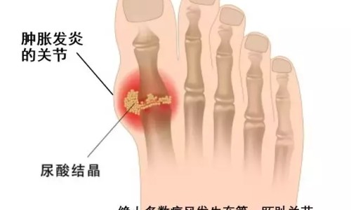 痛风病人能喝绿豆汤吗-痛风病人能喝玫瑰花吗网—知名的痛风病人可以喝牛奶吗网站,分享痛风病人能喝白酒吗?知识